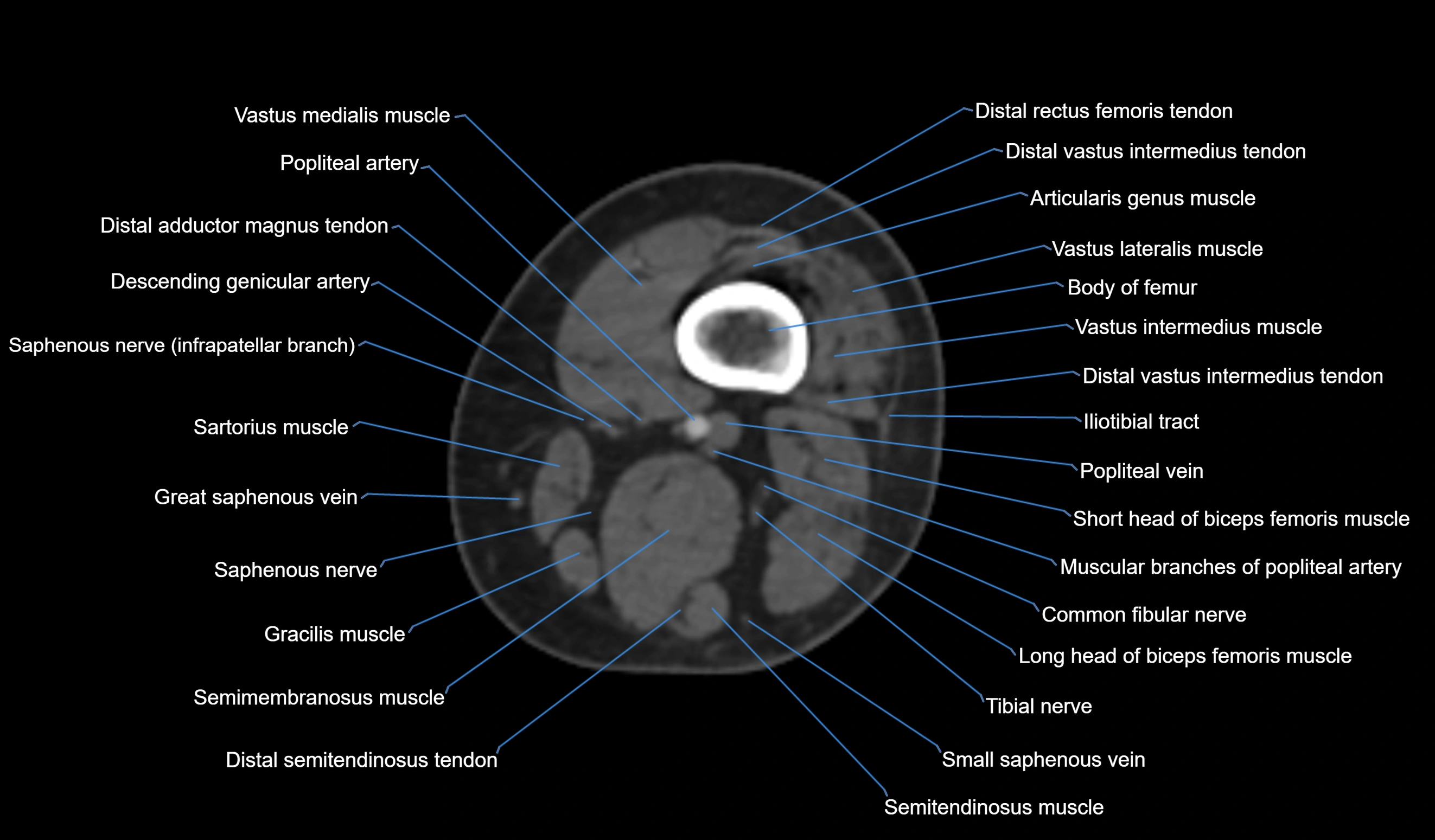 CT knee axial cross sectional anatomy labelled image-00003.webp